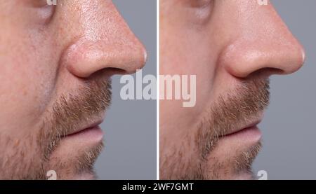 Mitesser-Behandlung, vor und nach. Collage mit Fotos des Mannes auf grauem Hintergrund, Nahaufnahme Stockfoto