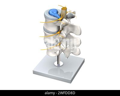 Abbildung eines Bandscheibenvorfalls der Lendenwirbelsäule, Stenose, Bandscheibenvorfall. 3D-Abbildung Stockfoto