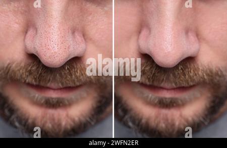 Mitesser-Behandlung, vor und nach. Collage mit Fotos des Mannes, Nahaufnahme Stockfoto