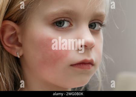 Rötung der Wangen des Kindes durch Ekzem, trockene Haut oder Allergie Stockfoto