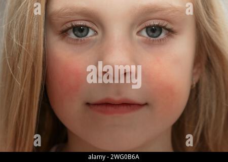 Rötung der Wangen des Kindes durch Ekzem, trockene Haut oder Allergie Stockfoto