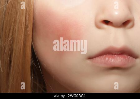 Rötung der Wangen des Kindes durch Ekzem, trockene Haut oder Allergie Stockfoto