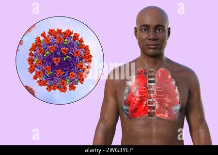 Mann mit Lungen von COVID-19-Pneumonie, Illustration Stockfoto