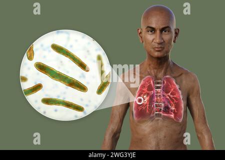 Mann mit Lungen von kavernöser Tuberkulose, Illustration Stockfoto