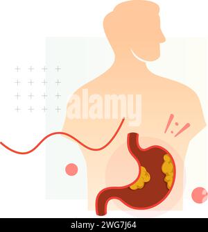 Magen - Magen - Krebs - Stock Illustration als EPS 10 Datei Stock Vektor