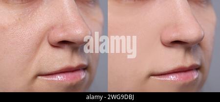 Alternde Hautveränderungen. Frau zeigt Gesicht vor und nach der Verjüngung, Nahaufnahme. Collage zum Vergleich der Hautbeschaffenheit Stockfoto