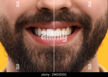 Mann zeigt Zähne vor und nach der Aufhellung auf orangefarbenem Hintergrund, Collage Stockfoto