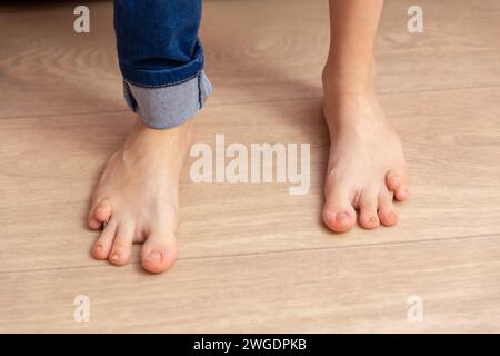 Nahaufnahme der Füße eines dreizehnjährigen Mädchens mit Geburtsfehler. Eine Behinderung verhindert, dass das Mädchen normal läuft und sich entwickelt. Stockfoto