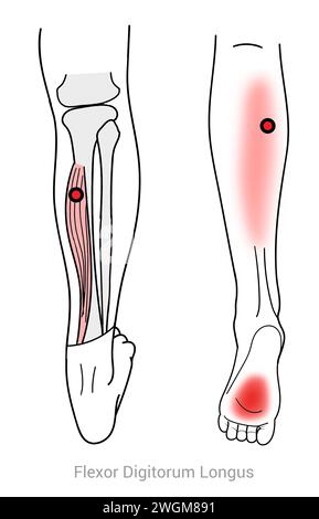 Flexor digitorum Longus: Myofasziale Triggerpunkte, die Schmerzen entlang der Wade in den Fuß und andere damit verbundene Schmerzstellen verursachen Stockfoto