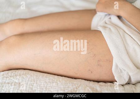 Krampfadern kleiner Gefässe auf der Haut des Oberschenkels einer Frau. Stockfoto