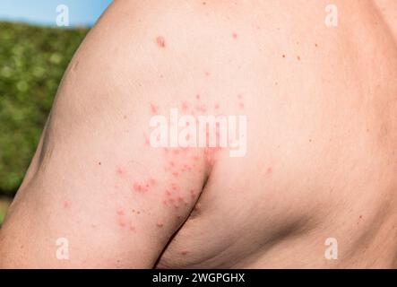Der Arm des Mannes mit Hautausschlag auf, Symptome des Juckens, Hautallergie. Stockfoto