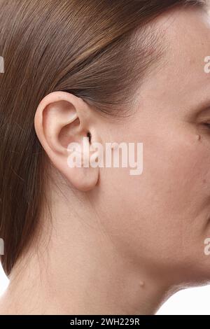 Grosse Naevuswarzen im Gesicht und Hals der kaukasischen Frau, Konzept der gutartigen oder bösartigen Neoplasien auf der menschlichen Haut, regelmäßige Untersuchung und Behandlung der Dermie Stockfoto