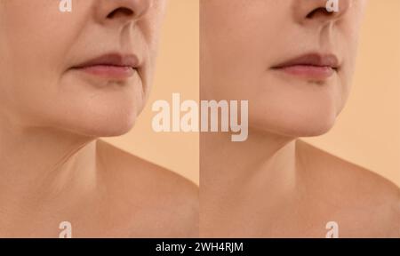 Alternde Hautveränderungen. Frau zeigt den Hals vor und nach der Verjüngung, Nahaufnahme. Collage zum Vergleich der Hautbeschaffenheit Stockfoto