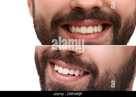 Mann zeigt Zähne vor und nach dem Aufhellen auf weißem Hintergrund, Collage Stockfoto