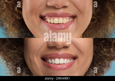 Frau zeigt Zähne vor und nach dem Aufhellen, Collage Stockfoto