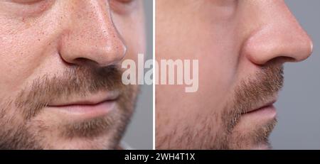 Mitesser-Behandlung, vor und nach. Collage mit Fotos des Mannes auf grauem Hintergrund, Nahaufnahme Stockfoto