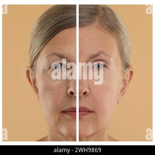 Alternde Hautveränderungen. Frau zeigt Gesicht vor und nach der Verjüngung, Nahaufnahme. Collage zum Vergleich der Hautbeschaffenheit Stockfoto