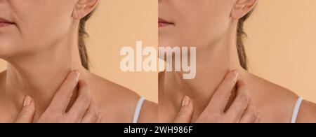 Alternde Hautveränderungen. Frau zeigt den Hals vor und nach der Verjüngung, Nahaufnahme. Collage zum Vergleich der Hautbeschaffenheit Stockfoto