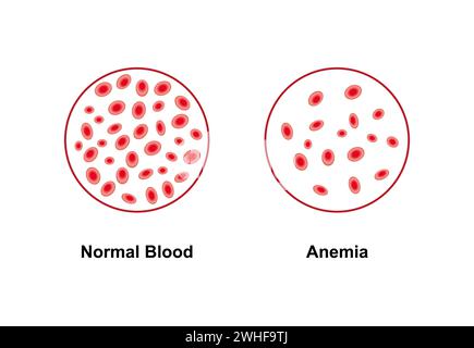 Normales und anämisches Blut, Illustration Stockfoto