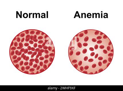 Normales und anämisches Blut, Illustration Stockfoto