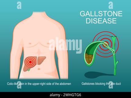 Gallensteinkrankheit. Menschlicher Körper mit Leber. Querschnitt der Gallenblase mit Gallensteinen, die einen Gallengang blockieren. Symptome der Cholelithiasis. Isomen Stock Vektor