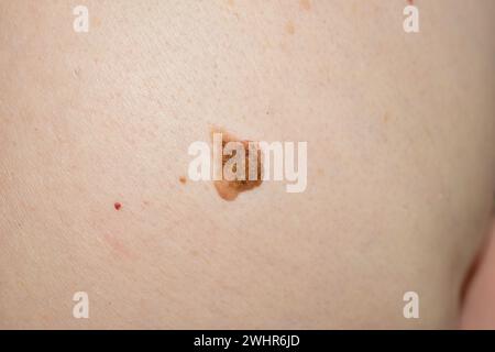 Eine Momentaufnahme eines großen braunen Maulwurfs auf dem Bauch einer Frau. Stockfoto