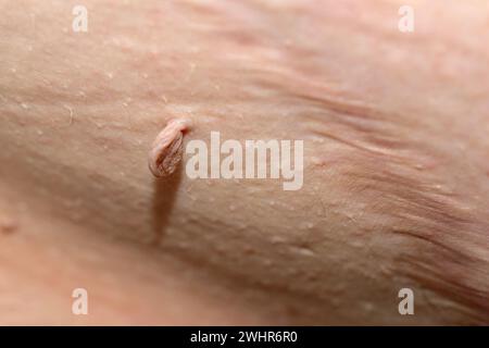 Eine Momentaufnahme eines langen Papilloms im Lager eines fetten Mannes im Bauch neben der Naht. Stockfoto