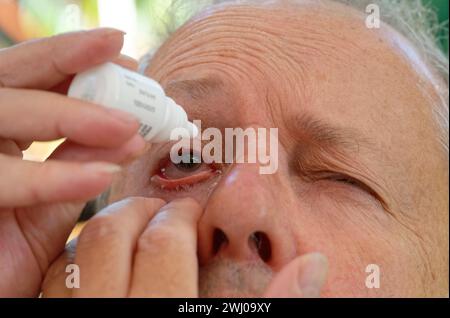 Einem Mann werden Augentropfen ins Auge nach einer Kataraktoperation gegeben Stockfoto