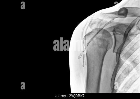 Röntgenbild eines auf schwarzem Hintergrund isolierten Schulterleuchtens. Chronische Bizepsluxation Stockfoto