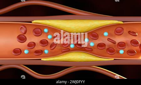 3D-Darstellung der Plaque-Bildung von Cholesterin in der Arterie (Atherosklerose) Stockfoto