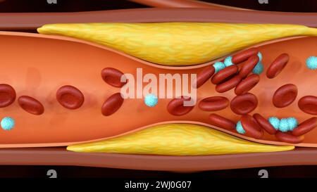 3D-Darstellung der Plaque-Bildung von Cholesterin in der Arterie (Atherosklerose) Stockfoto