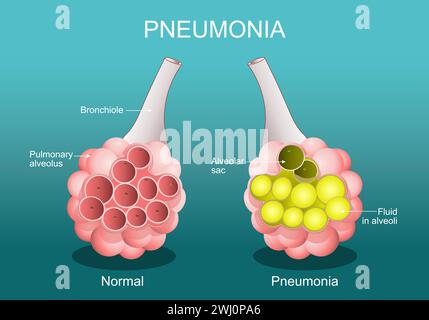 Pneumonie. Entzündungszustand der Lunge. Querschnitt der normalen Alveolen und Alveolen sind mit Flüssigkeiten gefüllt. Vektorposter. Isometrische Ebene Stock Vektor