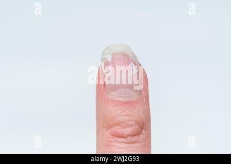 Ein weiblicher Finger mit gebissenen und gebrochenen Nägeln ohne Maniküre mit einer übergewachsenen Kutikula und einer beschädigten Nagelplatte nach dem Auftragen von Gelpolitur. Kosmetisch Stockfoto