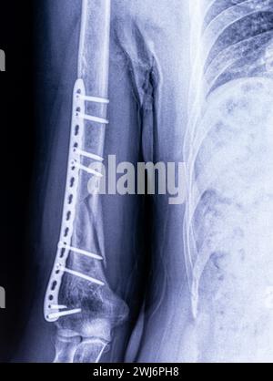 Röntgenbild der Osteosynthese einer Humerusfraktur bei einem Mann-Nahaufnahme Stockfoto