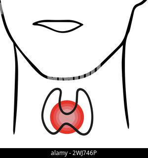 Vektorisolierte Darstellung der Schilddrüse. Die vergrößerte Schilddrüse. Stock Vektor