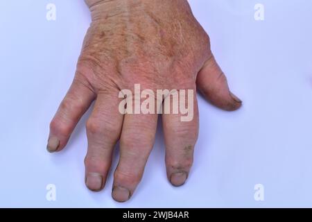 Entzündung der Gelenke der rechten Hand, Arthritis. Stockfoto