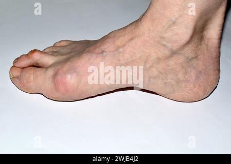 Das Bild zeigt den rechten Fuß des Beines, der von der Erkrankung des Hallux valgus betroffen ist. Stockfoto