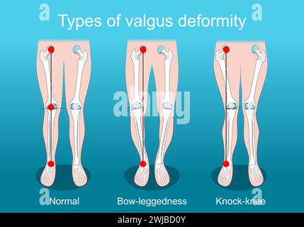 Valgusdeformitäten. Kniedeformität. Gesundes Gelenk, Klopfknie und Bow-Leggedness. Menschliche Beine, Knochen und Gelenke. Korrekturoperationen. Vektorposter. Iso Stock Vektor