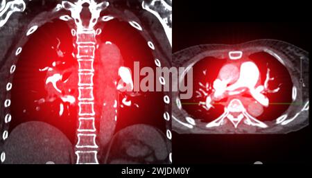 Eine CTA-Pulmonalarterie zeigt eine detaillierte Ansicht der Lungenblutgefäße und erfasst das Vorhandensein einer Lungenembolie, einer Erkrankung, bei der eine blutcl vorliegt Stockfoto
