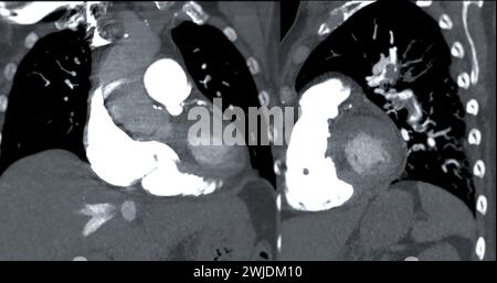 Eine CTA-Pulmonalarterie zeigt eine detaillierte Ansicht der Lungenblutgefäße und erfasst das Vorhandensein einer Lungenembolie, einer Erkrankung, bei der eine blutcl vorliegt Stockfoto