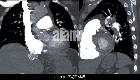 Eine CTA-Pulmonalarterie zeigt eine detaillierte Ansicht der Lungenblutgefäße und erfasst das Vorhandensein einer Lungenembolie, einer Erkrankung, bei der eine blutcl vorliegt Stockfoto