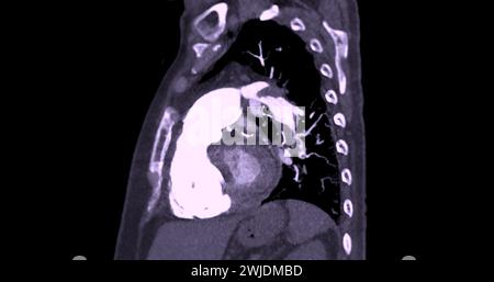 Eine CTA-Pulmonalarterie zeigt eine detaillierte Ansicht der Lungenblutgefäße und erfasst das Vorhandensein einer Lungenembolie, einer Erkrankung, bei der eine blutcl vorliegt Stockfoto