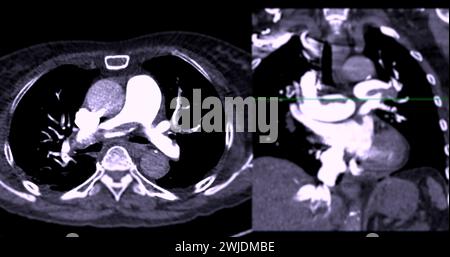 Eine CTA Pulmonalarterie zeigt eine detaillierte Ansicht der Lungenblutgefäße und erfasst das Vorhandensein einer Lungenembolie. Stockfoto