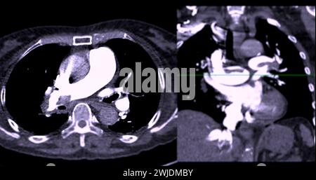 Eine CTA-Pulmonalarterie zeigt eine detaillierte Ansicht der Lungenblutgefäße und erfasst das Vorhandensein einer Lungenembolie, einer Erkrankung, bei der eine blutcl vorliegt Stockfoto