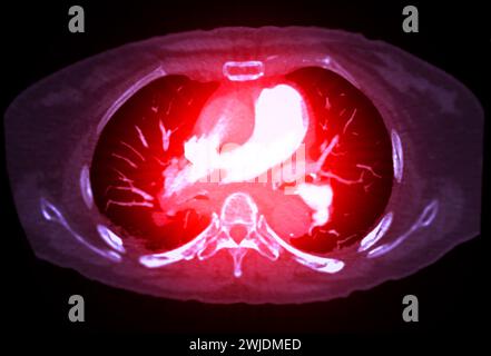 Eine CTA-Pulmonalarterie zeigt eine detaillierte Ansicht der Lungenblutgefäße und erfasst das Vorhandensein einer Lungenembolie, einer Erkrankung, bei der eine blutcl vorliegt Stockfoto