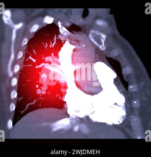 Eine CTA-Pulmonalarterie zeigt eine detaillierte Ansicht der Lungenblutgefäße und erfasst das Vorhandensein einer Lungenembolie, einer Erkrankung, bei der eine blutcl vorliegt Stockfoto