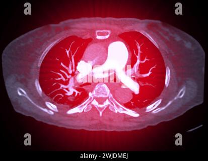 Eine CTA-Pulmonalarterie zeigt eine detaillierte Ansicht der Lungenblutgefäße und erfasst das Vorhandensein einer Lungenembolie, einer Erkrankung, bei der eine blutcl vorliegt Stockfoto