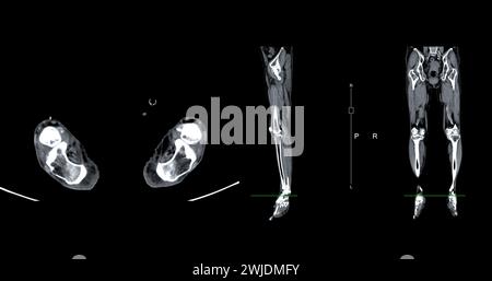 Ein CT-Venogramm des Beines ist ein nicht-invasives Bildgebungsverfahren, das detaillierte Visualisierungen der Beinvenen ermöglicht. Stockfoto