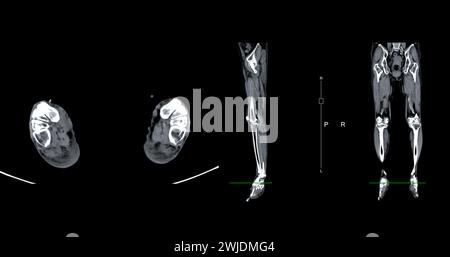 Ein CT-Venogramm des Beines ist ein nicht-invasives Bildgebungsverfahren, das detaillierte Visualisierungen der Beinvenen ermöglicht. Stockfoto