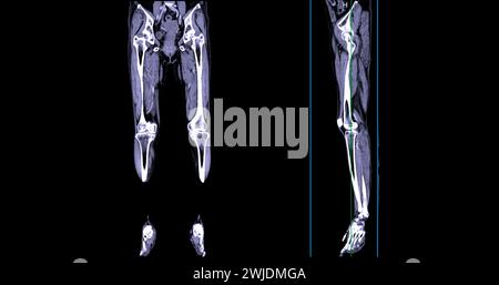 Ein CT-Venogramm des Beines ist ein nicht-invasives Bildgebungsverfahren, das detaillierte Visualisierungen der Beinvenen ermöglicht. Stockfoto